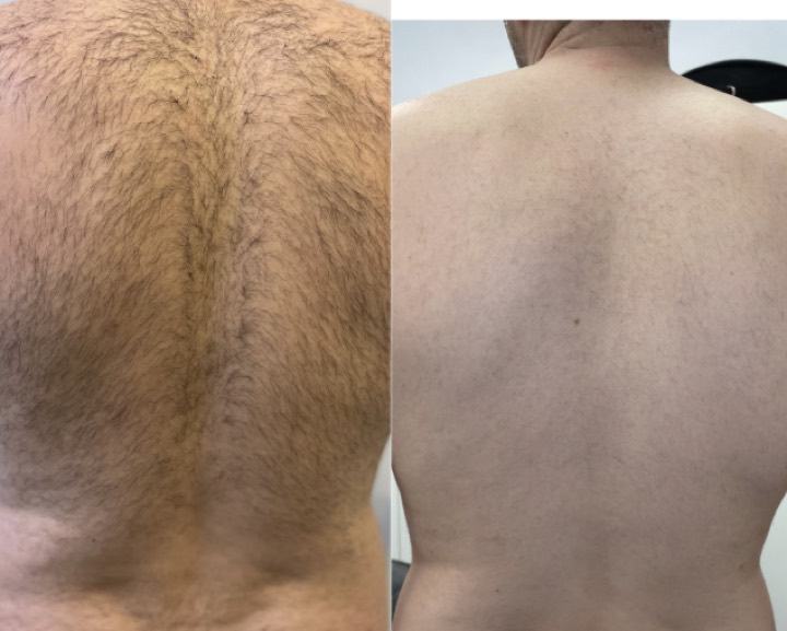 Avant après épilation laser - Dos