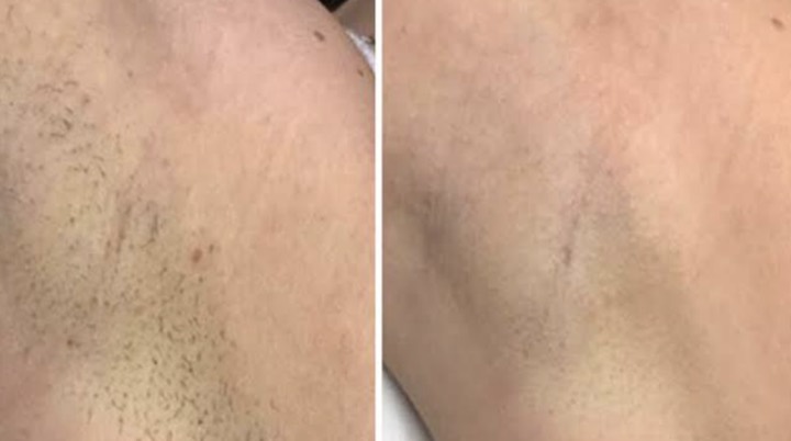 Avant après épilation laser - Aisselles