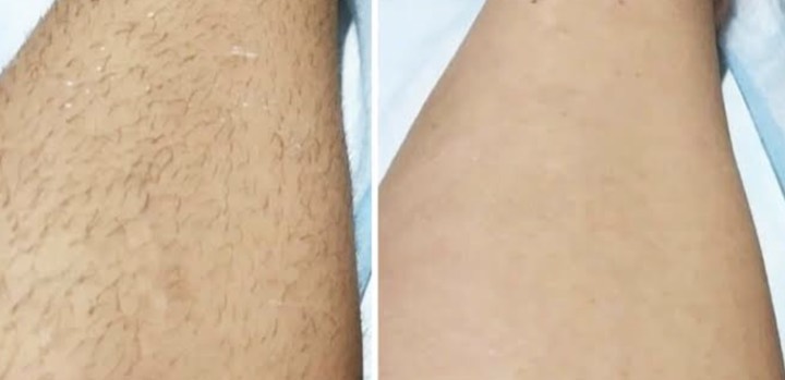 Avant après épilation laser - Jambe